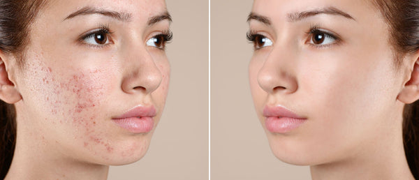 Say Goodbye to Acne and Hello to Flawless Skin: How to Tackle Common Skin Problems